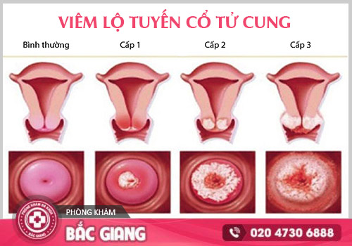 Bệnh phụ khoa âm thầm gây hại - Đừng chủ quan với dấu hiệu